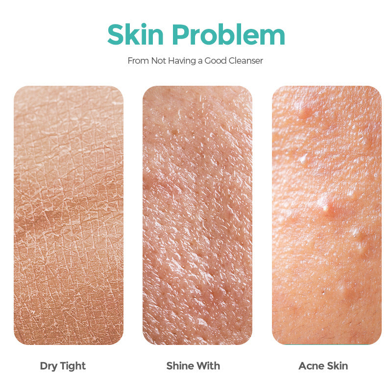 Salicylate Acne Wash Moisturizing And Purifying